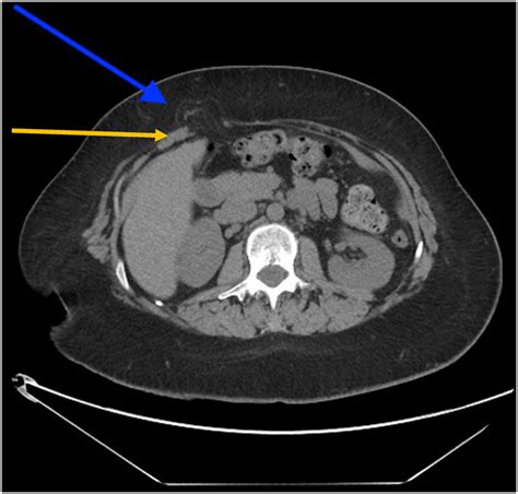 Ct Scan Axial View Of The Right Upper Quadrant Incisional Hernia Blue