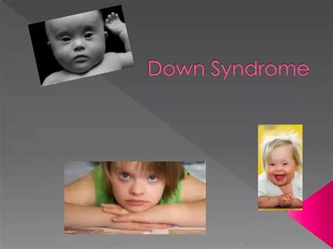 Ppt Down Syndrome Powerpoint Presentation Free Download Id2350563