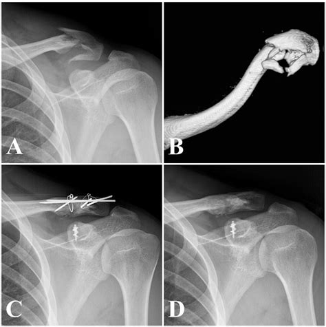 Figure 2 From Modified Tension Band Fixation And Coracoclavicular