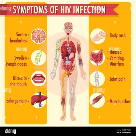 Symptoms Of Hiv Infection Infographic Illustration Stock Vector Image Art Alamy