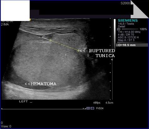 Scrotal Edema Ultrasound