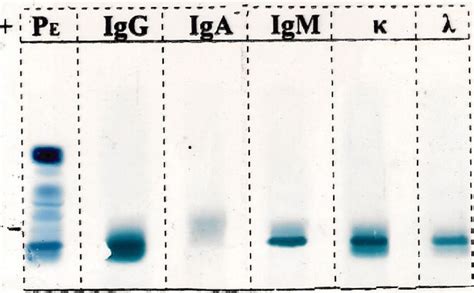 Serum Protein Electrophoresis And Immunofixation Of The Immunoglobulin