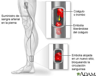 La trombosis arterial afecta las arterias o circulación de salida del corazón, mientras que la venosa afecta las venas o circulación de retorno. Embolia arterial: MedlinePlus enciclopedia médica