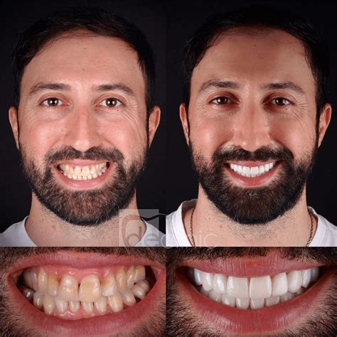 Smile Makeover Dental Excellence Turkey Dental Clinic In Antalya Turkey