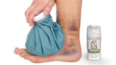 5 Tips To Get Rid Of Bruises Cbd Lion