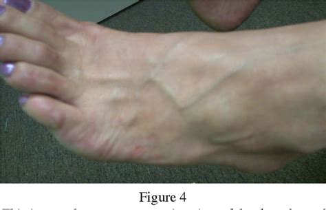 Figure From Ganglion Cyst Of The Foot Treated With Electroacupuncture