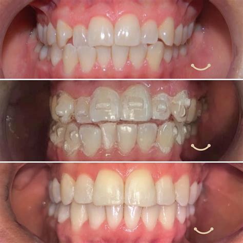 Clear Aligners In Orthodontics Invisalign Attachments Dentist Reviews