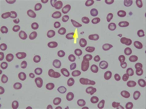 Sickle Cells Peripheral Blood Smear