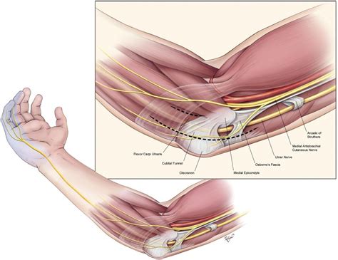 Cubital Tunnel Syndrome Fort Worth Tx The Hand To Shoulder Center