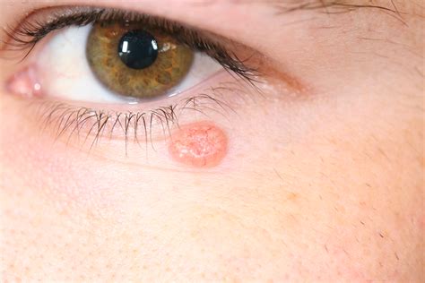 Characteristics Of Eyelid Basal Cell Carcinoma Arte Facial Hot Sex Picture