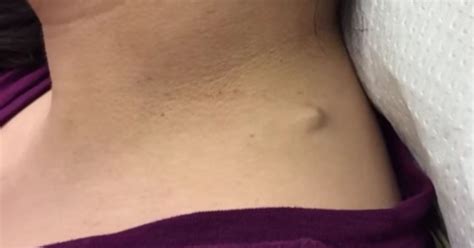Dr Pimple Popper Removes Gross Three Year Old Cyst From Womans Neck