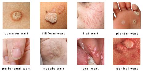 Types Of Warts Health Vision