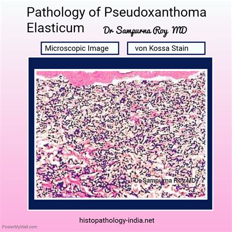 Pathology Of Pseudoxanthoma Elasticum Von Kossa Stain