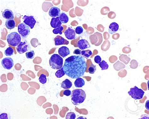 Marrow Histiocytosis 4