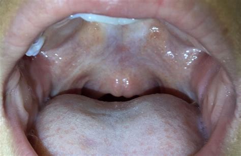 Say ‘ahh Assessing Structural And Functional Palatal Issues In