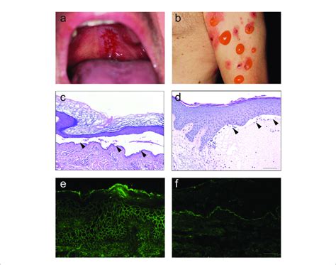 Clinical Histological And Immunological Features Of Pemphigus And