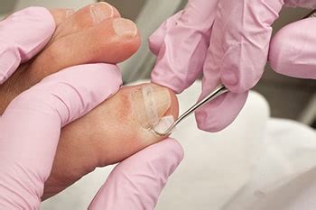 Please feel free to let me know if anything. irene wang. Ingrown Toenail Treatment - Westland, MI 48185 Foot Doctor ...