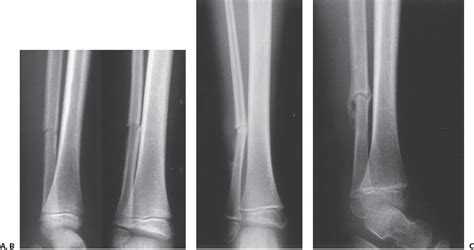 Fractures Of The Shaft Of The Tibia And Fibula Musculoskeletal Key