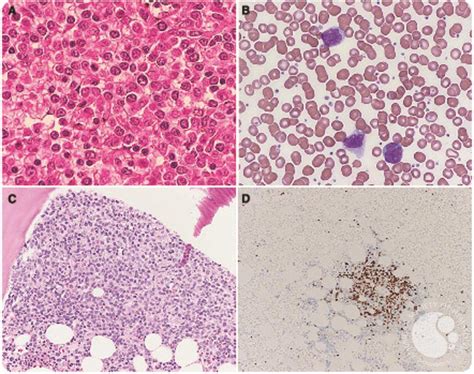 Spontaneous Splenic Rupture In Mantle Cell Lymphoma With Leukemic Variant