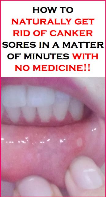 How Long Do Canker Sores Last Different Healing Stages And Home