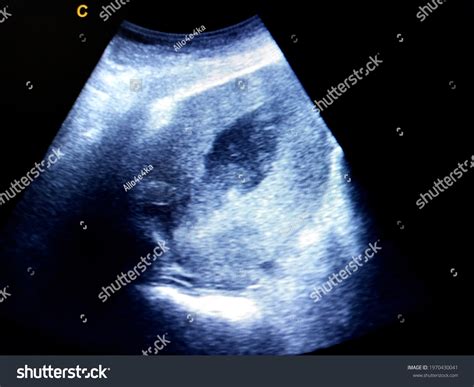 Intrauterine Hematoma After Delivery By Ultrasound Stock Photo Edit