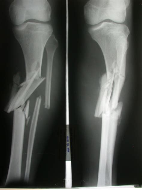a pathological comminuted fracture causes consequences and treatment steve gallik