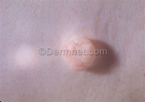 Skin Tags Polyps Photo Skin Disease Pictures