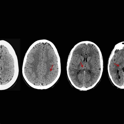 Diffuse axonal injury typically causes loss of consciousness that lasts for more than 6 hours. Diffuse axonal injury: CT and MRI typical findings | Eurorad