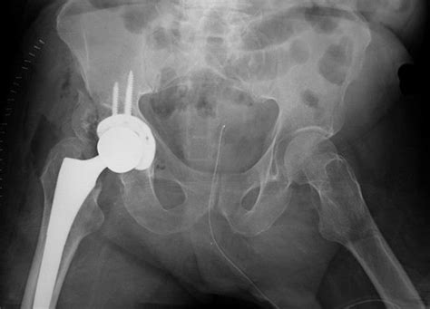 Acetabular Fractures Orthoinfo Aaos