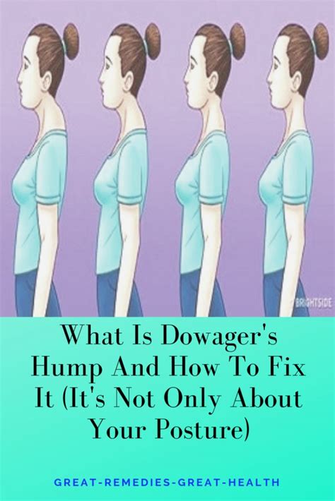 Invisalign treatment is the clear alternative to metal braces for kids, teens, and adults. What Is Dowager's Hump And How To Fix It (It's Not Only ...