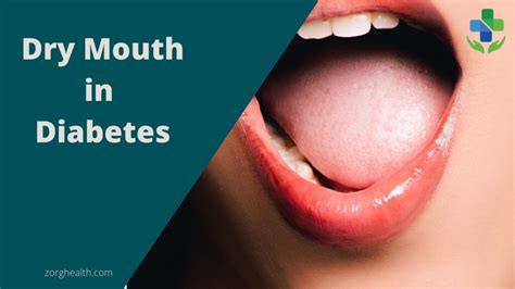 How To Manage Dry Mouth In Diabetes Zorg Health