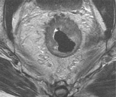 Rectal Cancer In The 21st Century—radical Operations Anterior