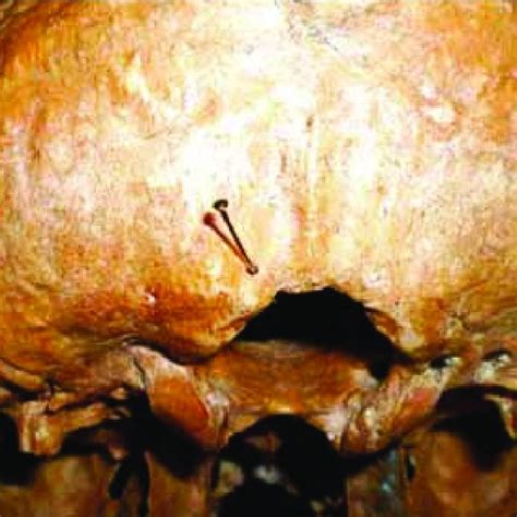 Pdf Occipital Emissary Foramina In Human Skulls An Anatomical