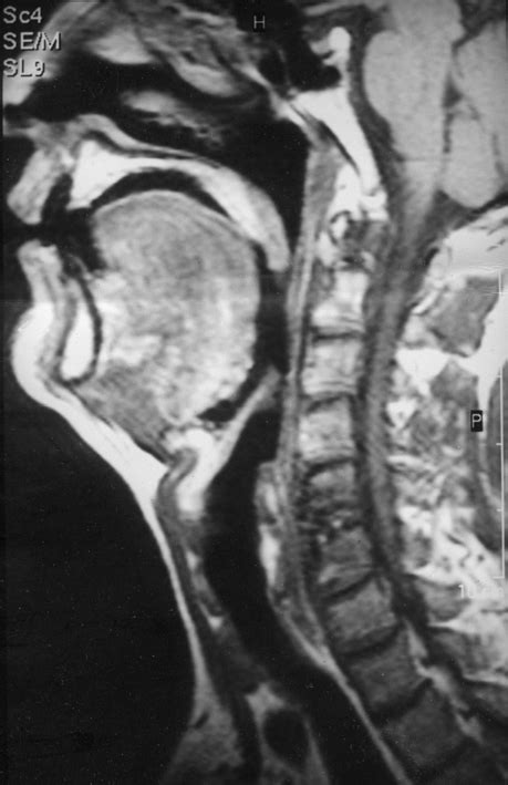 Mri Of The Head And Neck Showing That The Uvula Contacted The Posterior