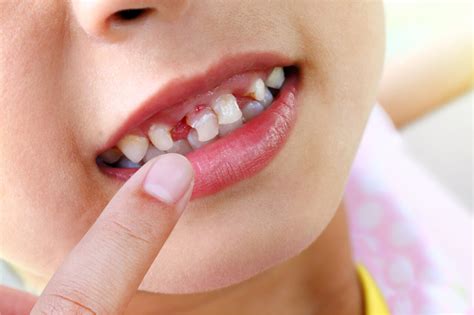 Dealing With White Spots On Child´s Teeth