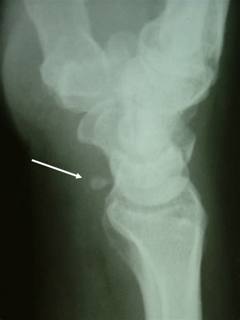 Lateral Radiograph Of The Wrist Showing The Sesamoid Anterior To The