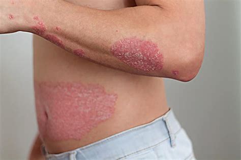 Biologics Hives Psoriasis Hidradenitis Suppurativa There Is An Effective Treatment Hope