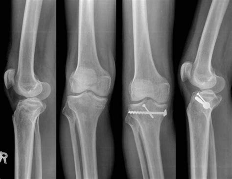 Tibial Plateau Fractures Musculoskeletal Medicine For Medical