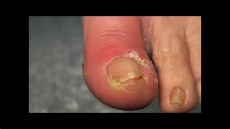 Ingrowing Toe Nail On A Diabetic Foot Youtube