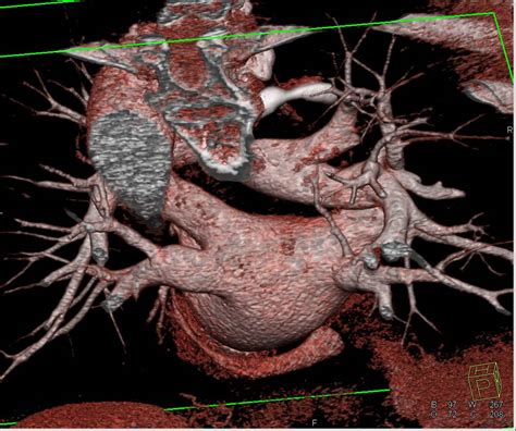 3d Mapping Of The Pulmonary Veins And Artery Cardiac Case Studies