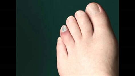 Swollen Toe Causes Youtube
