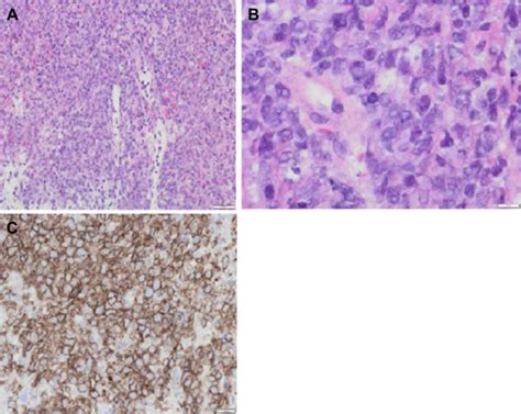 The Vanishing Adrenal Glands A Transient Regression Of Adrenal