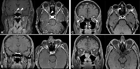 Magnetic Resonance Imaging Abnormalities Of The Optic Nerve