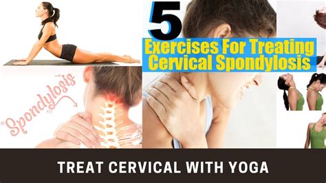 Cervical Spondylosis Exercises