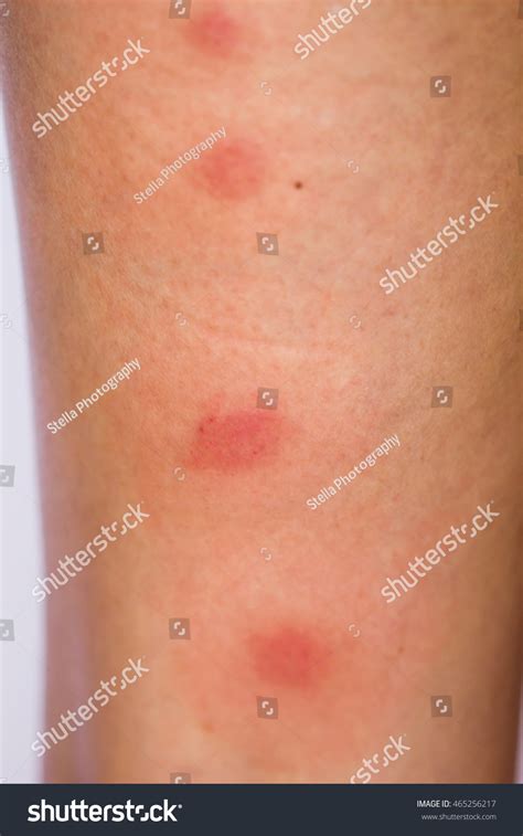 Leg Red Spot Caused By Insect Stock Photo 465256217 Shutterstock