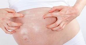 Itchy skin during pregnancy