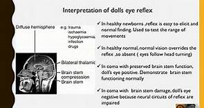 Doll's eye Reflex