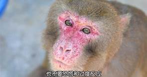 猴痘疫情严峻，我国多地发现猴痘病例 如何防控？