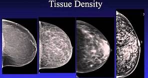 Introduction to Mammography