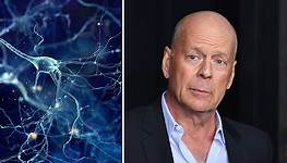 Bruce Willis: Was hinter der seltenen Erkrankung frontotemporale Demenz steckt